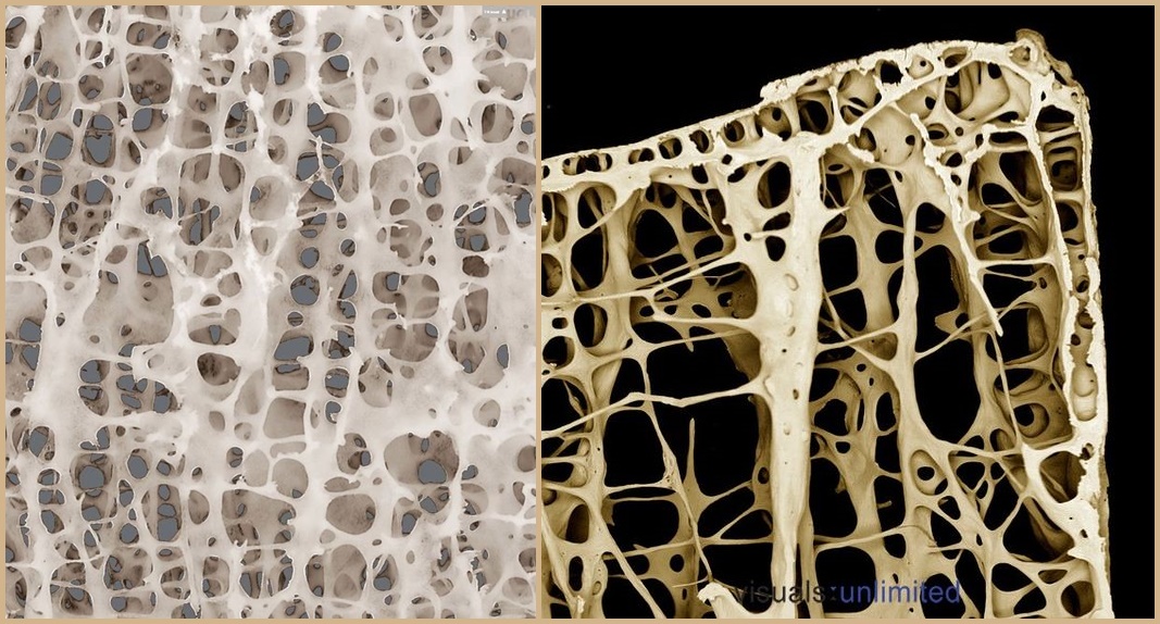 Fortalecendo o esqueleto - depois osteoporose e osteopenia