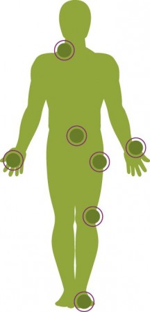 Artrose a "dor nas juntas"