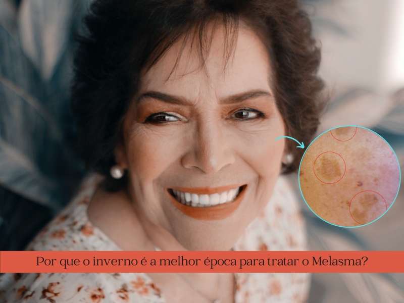 Por que o inverno é a melhor época para tratar Melasma?